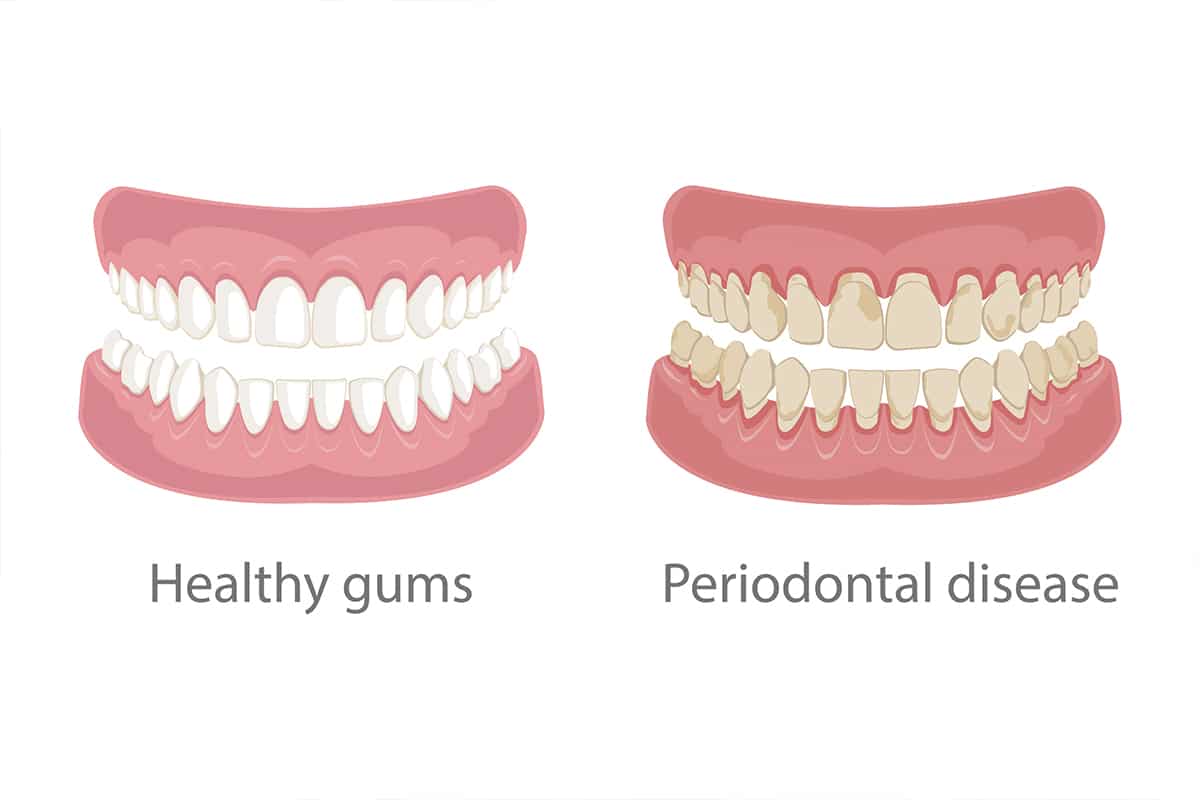 4 Signs You Have Periodontal Gum Disease