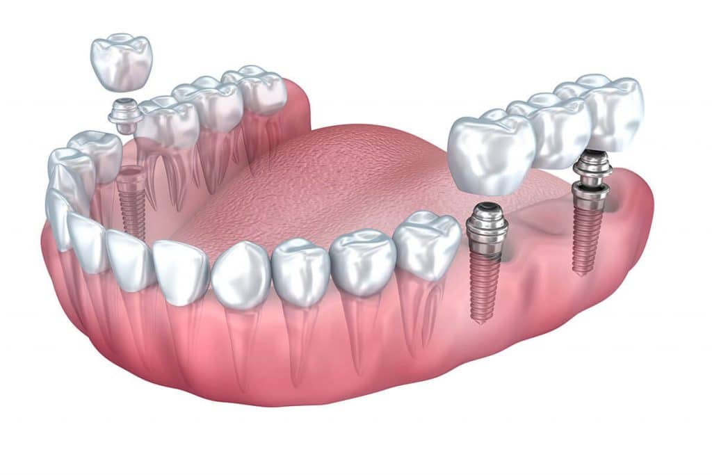 Dental Implant vs Bridge: Know Your Options | Smile Shack